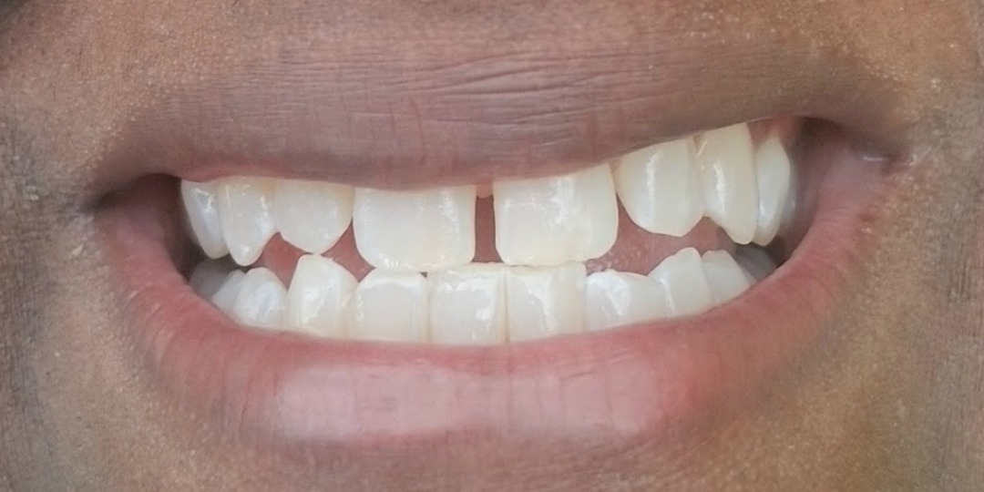 TEETH WHITENING FOR SENSITIVE TEETH with Smile Brilliant