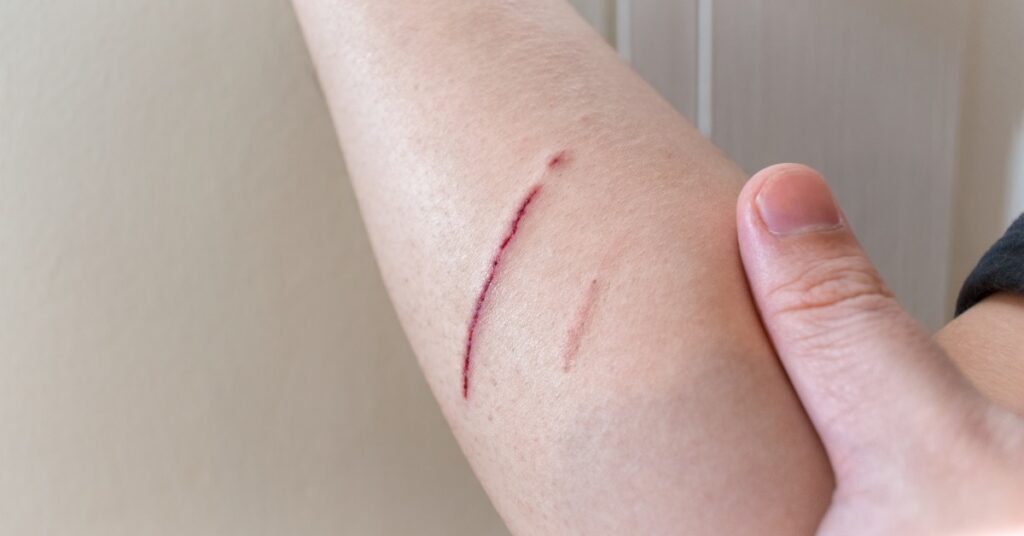 A close-up of a kid’s arm with a small straight cut next to a small scrape with a brown wall on the background.
